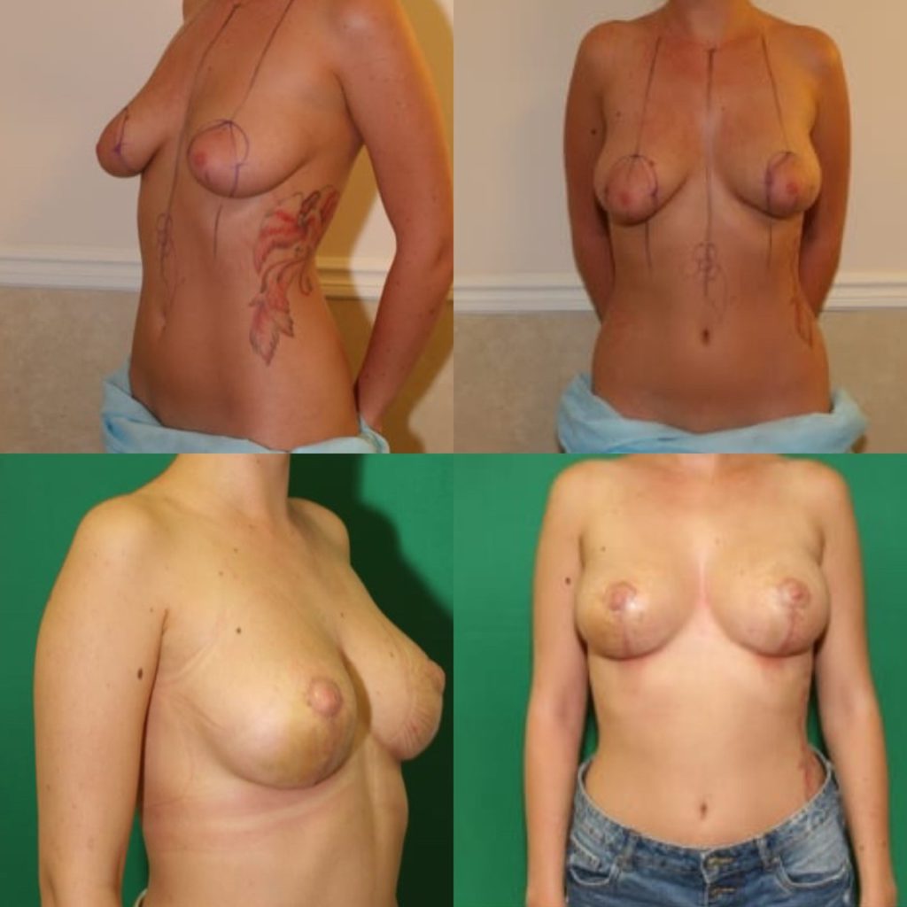 голая грудь после родов фото до и после фото 82