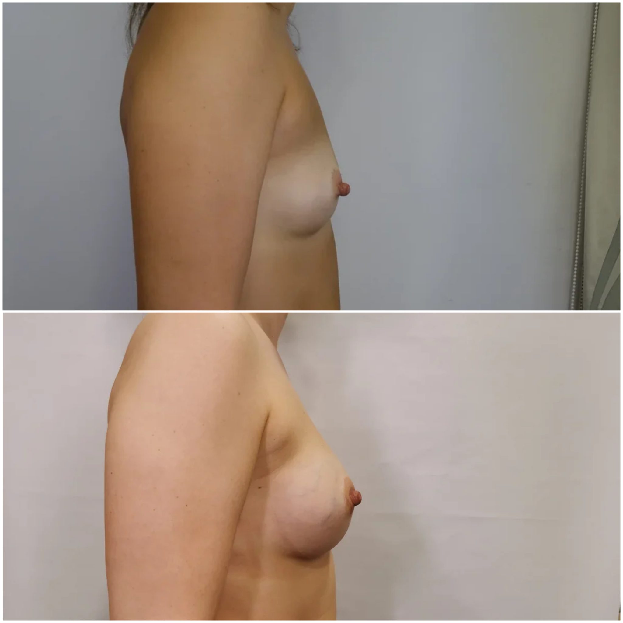 импланты для 3 размера груди фото 71